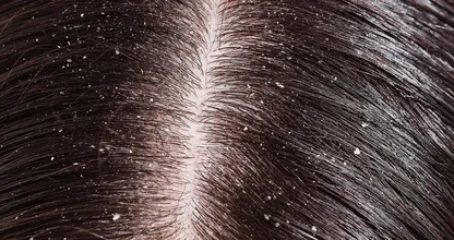 Heb jij last van roos? Dan moet je DIT natuurlijke middeltje eens proberen! Werkt beter dan anti roosshampoo!