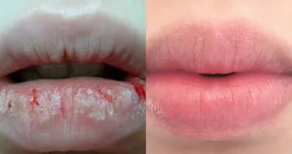 Machen dir trockene, spröde und eingerissene Lippen im Winter auch zu schaffen? DAS ist der Grund!