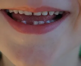 Bewahre die Milchzähne deiner Kinder unbedingt auf! Sie könnten ihnen eines Tages das Leben retten.