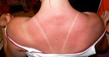 Zo heelt je huid sneller als je bent verbrand