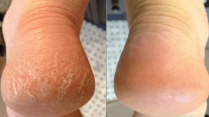 Débarrassez-vous de vos talons secs grâce à un produit bon marché que nous avons tous dans notre cuisine