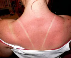 This is why you should never peel your skin when you have a sunburn