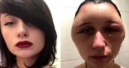 Studente Estelle kreeg een ‘hoofd als een gloeilamp’ na heftige allergische reactie op haarverf
