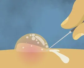 'Blasen muss man immer aufstechen': wahr oder nicht? Das ist die Antwort!