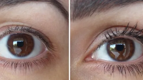 ¿Sufres de párpados caídos? ¡Entonces echa un vistazo a ESTA maravilla! ¿Levantamiento natural con...?