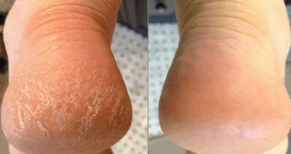 Débarrassez-vous de vos talons secs grâce à un produit bon marché que nous avons tous dans notre cuisine