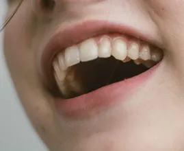 5 natuurlijke geneesmiddelen voor tandvleesontsteking